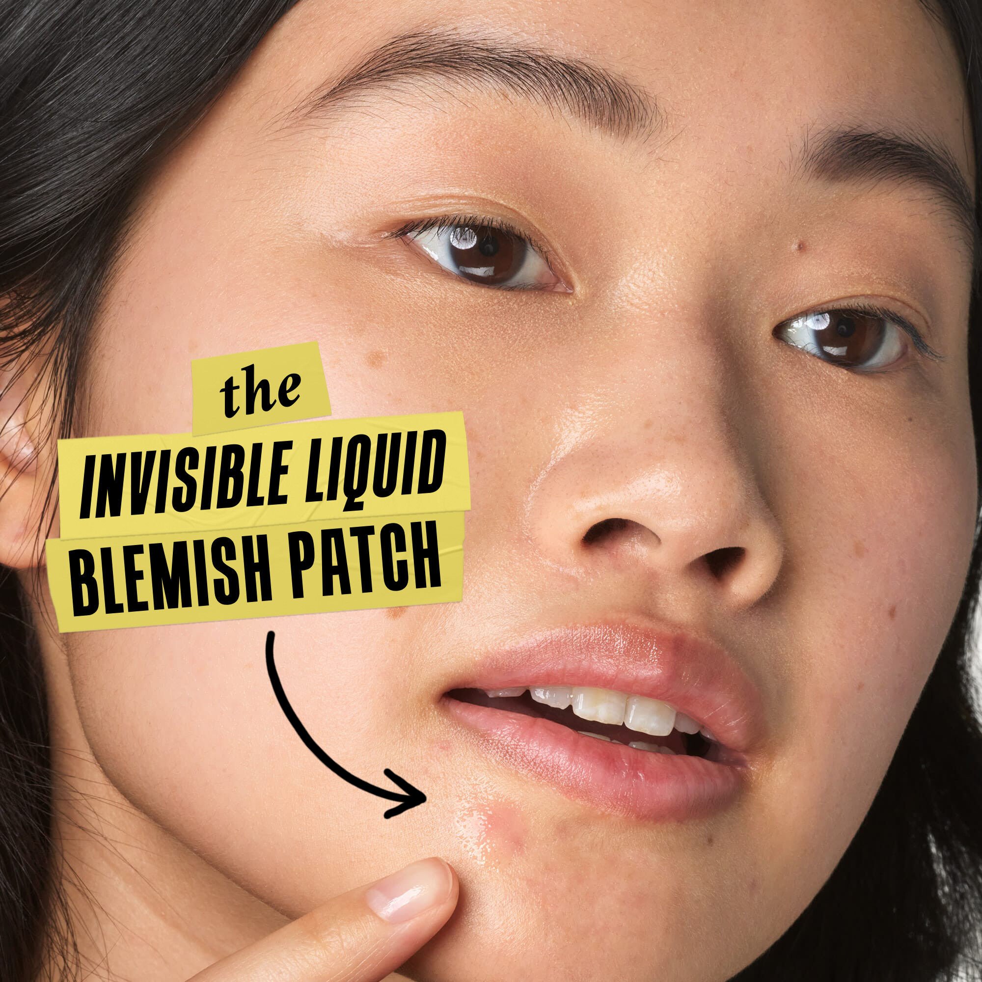 Truly Targeted Acne-Clearing Solution — Pimple Patch