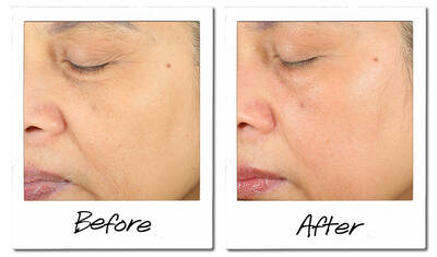 A side-by-side comparison of a person's face, showing a close-up of their skin. The left side is labeled "Before" and displays visible wrinkles and uneven texture. The right side is labeled "After" and shows smoother, more refined skin with a healthier appearance.