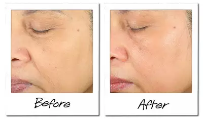 A side-by-side comparison of a person's face, showing a close-up of their skin. The left side is labeled "Before" and displays visible wrinkles and uneven texture. The right side is labeled "After" and shows smoother, more refined skin with a healthier appearance.
