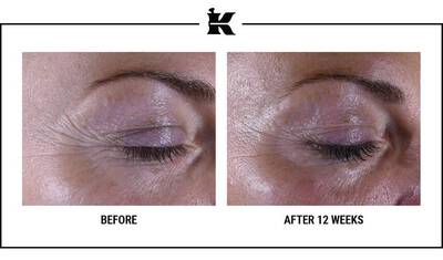 A side-by-side comparison of an eye area before and after 12 weeks of treatment, showing reduced wrinkles and improved skin texture.