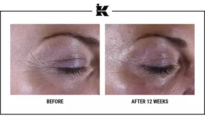 A side-by-side comparison of an eye area before and after 12 weeks of treatment, showing reduced wrinkles and improved skin texture.