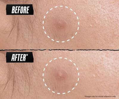 Before and after comparison of a blemish on skin. The left image shows an inflamed blemish, while the right image shows a reduced and less noticeable blemish after treatment.