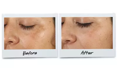 A side-by-side comparison of a woman's face showing skin texture before and after a treatment. The "Before" image shows blemishes and uneven tone, while the "After" image displays smoother, clearer skin.