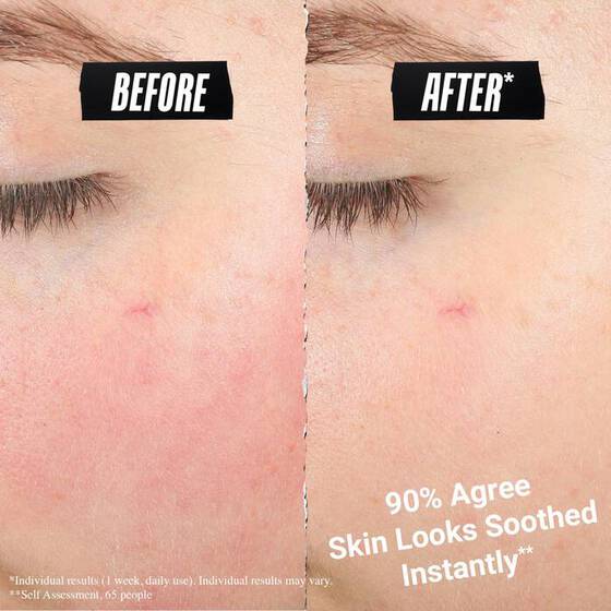 Before and after skin repair photo using Ultra Facial Meltdown Recovery Cream 